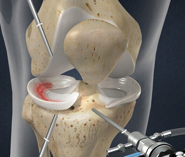 Meniscus Surgery